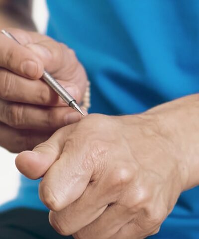 Akupunktur an der Hand mit AkuPen