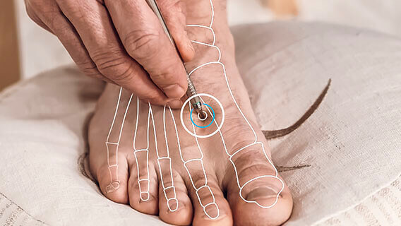 Foot with graphic, position of acupuncture point LE 03 is shown with AkuPen
