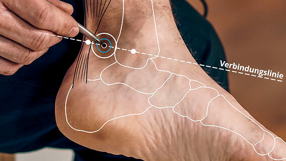 Foot with graphic, position of acupuncture point NI 03 is shown with AkuPen
