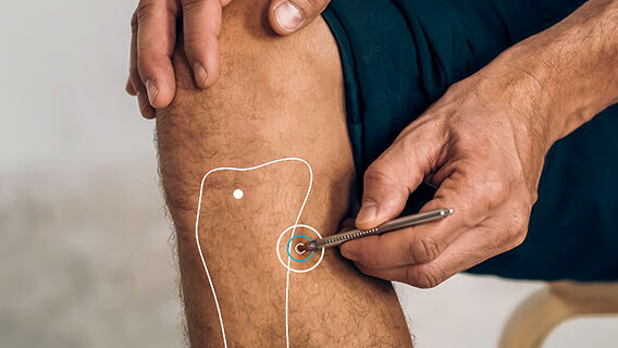 Graphical representation of the location of the acupuncture point MP 09 below the knee.