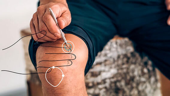 Grafische Darstellung der Lage des Akupunkturpunkts MP 10 oberhalb des Knies