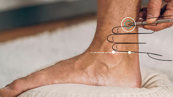 Graphical representation of the location of the acupuncture point NI 07 on the leg.