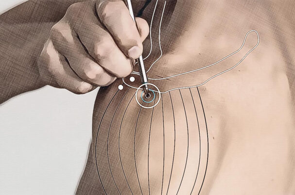 Location acupuncture point TB 14 Location acupuncture point TB 14 Graphic