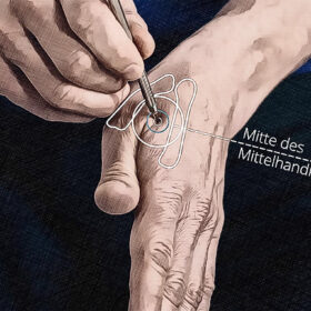 Lage Akupunkturpunkt Di 04 Grafik