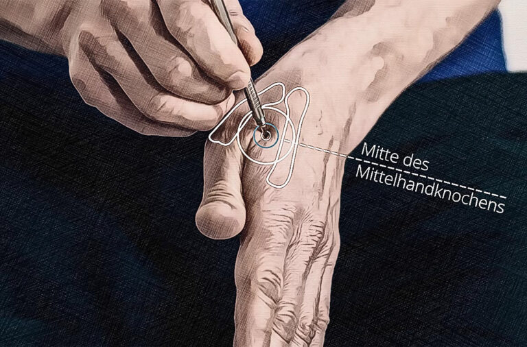 Localización del punto de acupuntura Mar 04 Gráfico