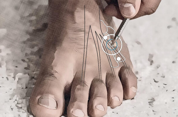 Emplacement du point d'acupuncture VB 41 Graphique