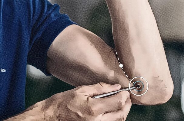 Location acupuncture point Ht 03 Graphic