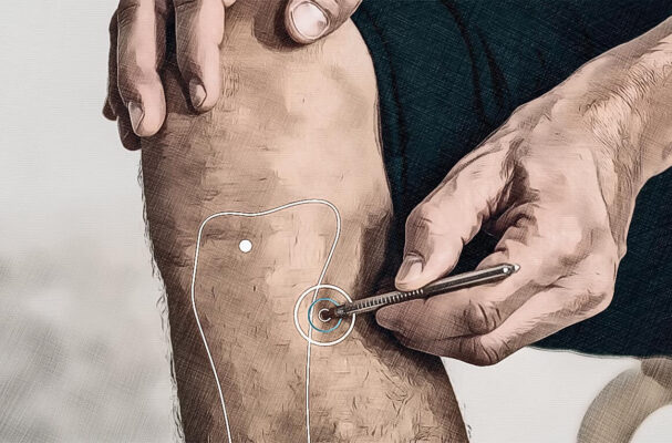 Location acupuncture point Sp 09 Graphic