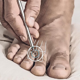 Localización del punto de acupuntura Ma 44 Gráfico